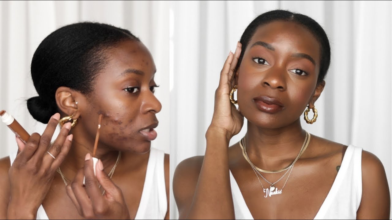 How to hide acne scars without makeup